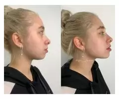 Cosmetology, lip augmentation - 2