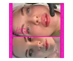 Cosmetology, lip augmentation - 10