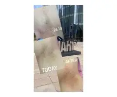 Электроэпиляция